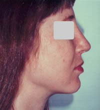 Rhinoplastie après
