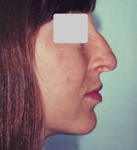 Rhinoplastie avant